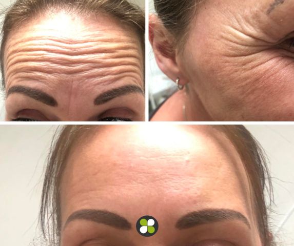 Before and after photos of a woman who has had anti-wrinkle treatment at Shamrock Clinic in Lower Stondon, Bedfordshire